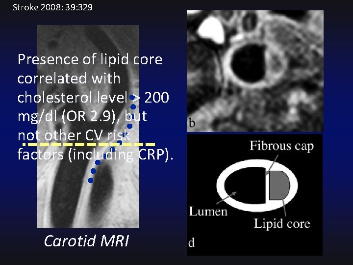 Stroke 2008: 39: 329 Presence of lipid core correlated with cholesterol level > 200