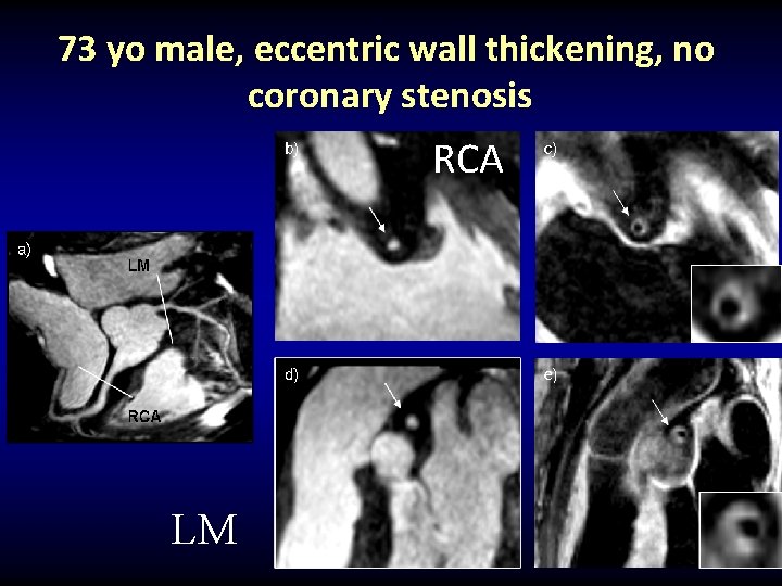 73 yo male, eccentric wall thickening, no coronary stenosis RCA LM 