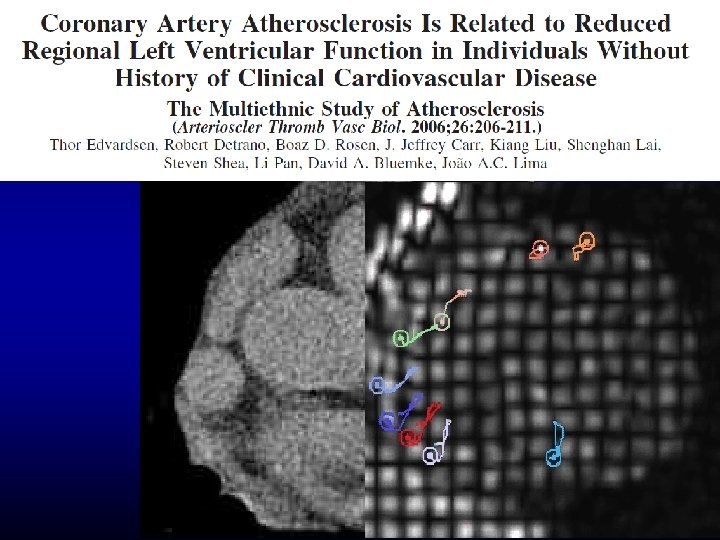 osis (Coronary Calcification) and Local Myocardia 