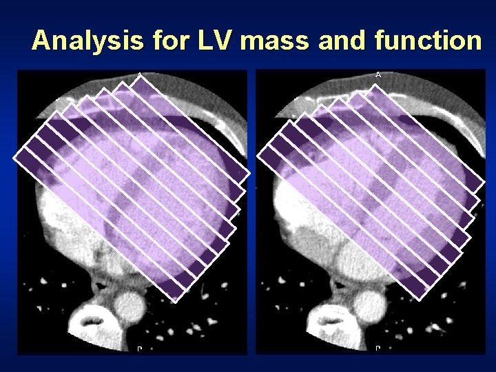 Analysis for LV mass and function 