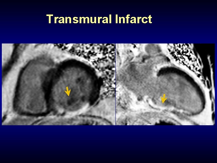 Transmural Infarct 