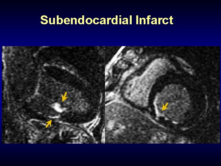 Subendocardial Infarct 