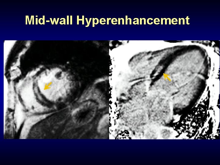 Mid-wall Hyperenhancement 