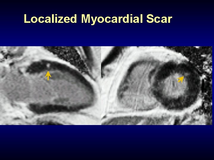 Localized Myocardial Scar 