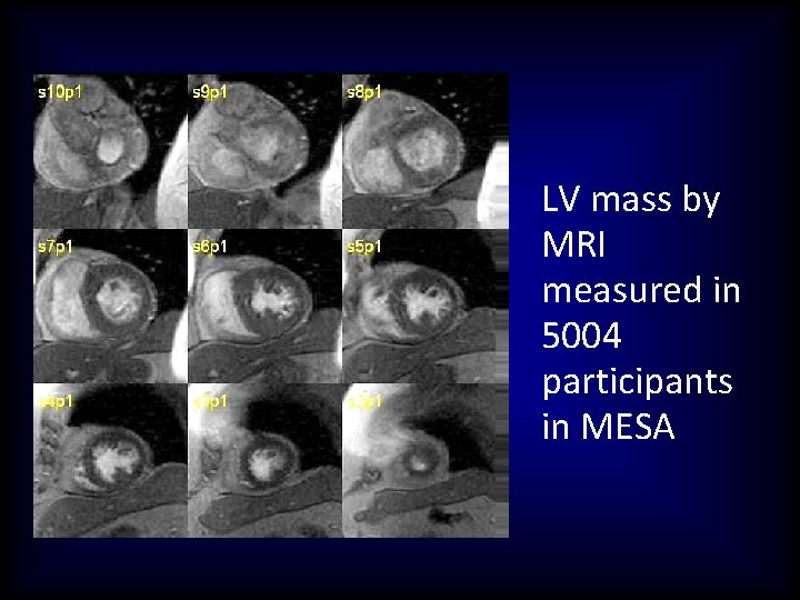 LV mass by MRI measured in 5004 participants in MESA 