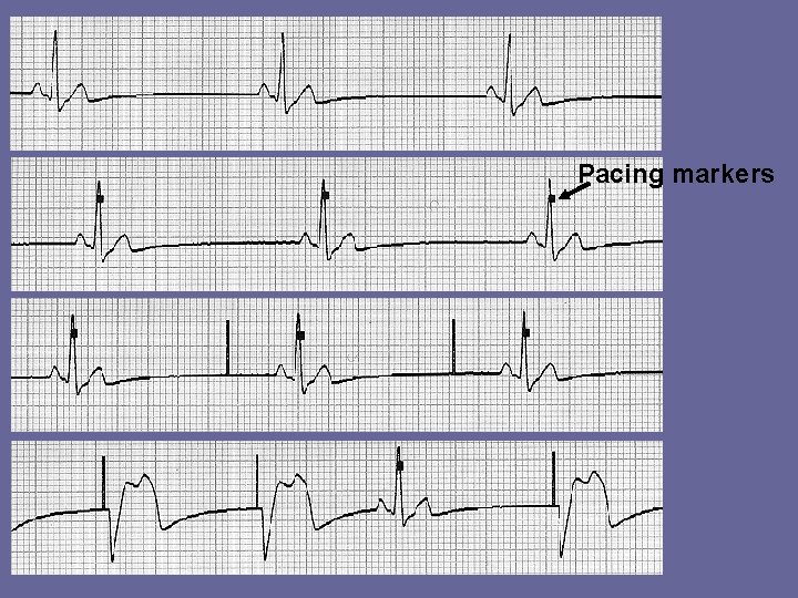 Pacing markers 