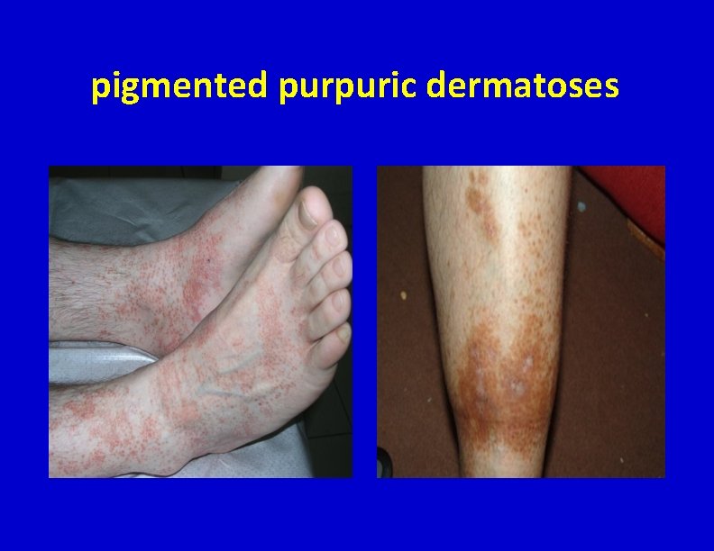 pigmented purpuric dermatoses 