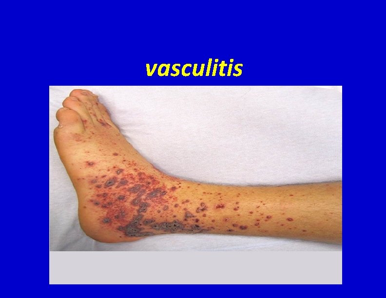 vasculitis 