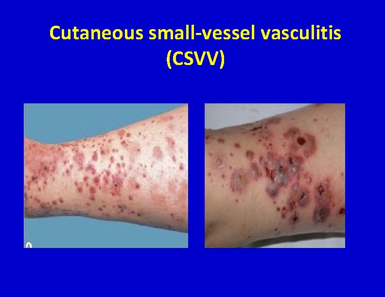 Cutaneous small-vessel vasculitis (CSVV) 