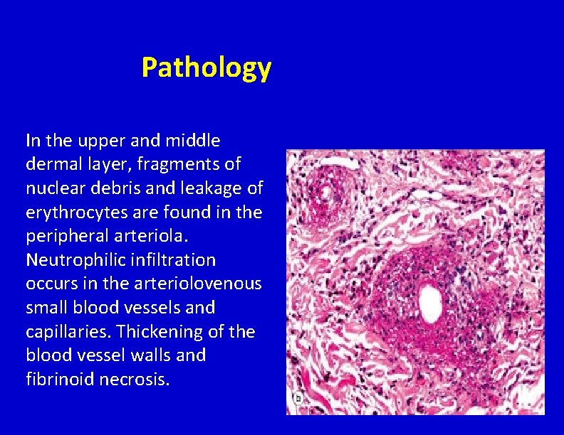 Pathology In the upper and middle dermal layer, fragments of nuclear debris and leakage