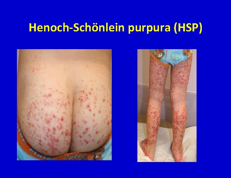 Henoch-Schönlein purpura (HSP) 