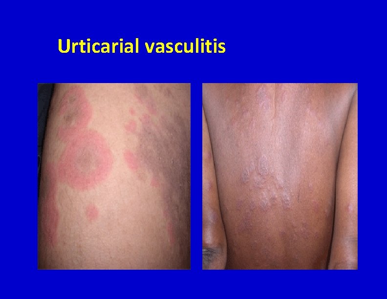 Urticarial vasculitis 