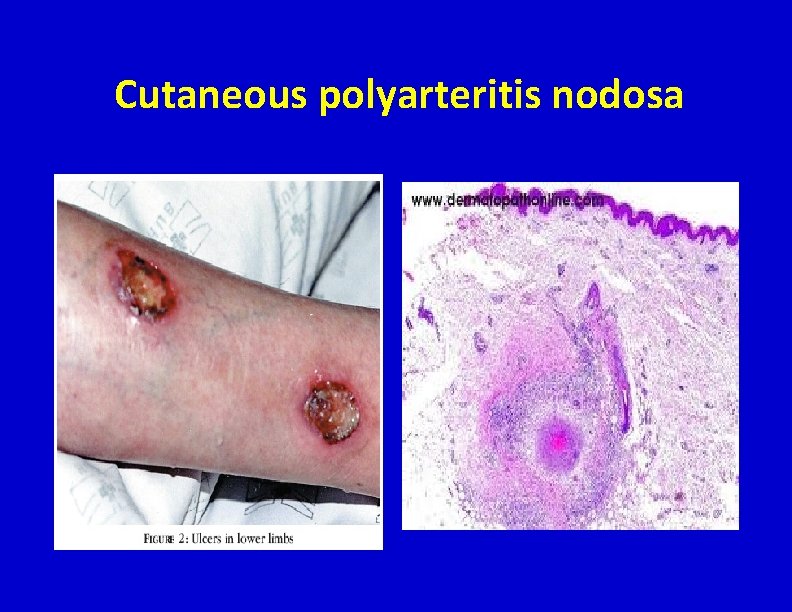 Cutaneous polyarteritis nodosa 