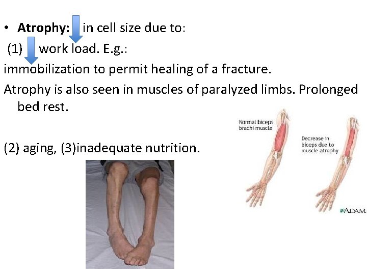  • Atrophy: in cell size due to: (1) work load. E. g. :