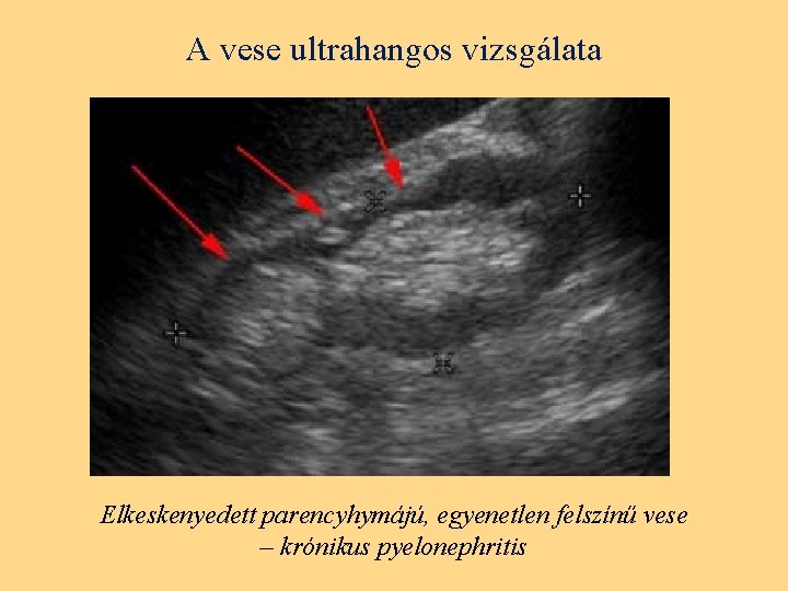 A prosztatarák epidemiológiája - PDF Ingyenes letöltés - Asymptomatic prostatitis psa levels