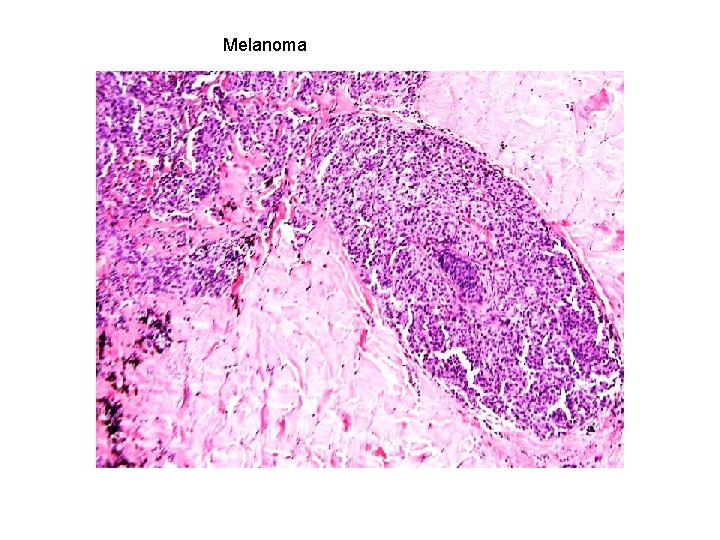 Melanoma 