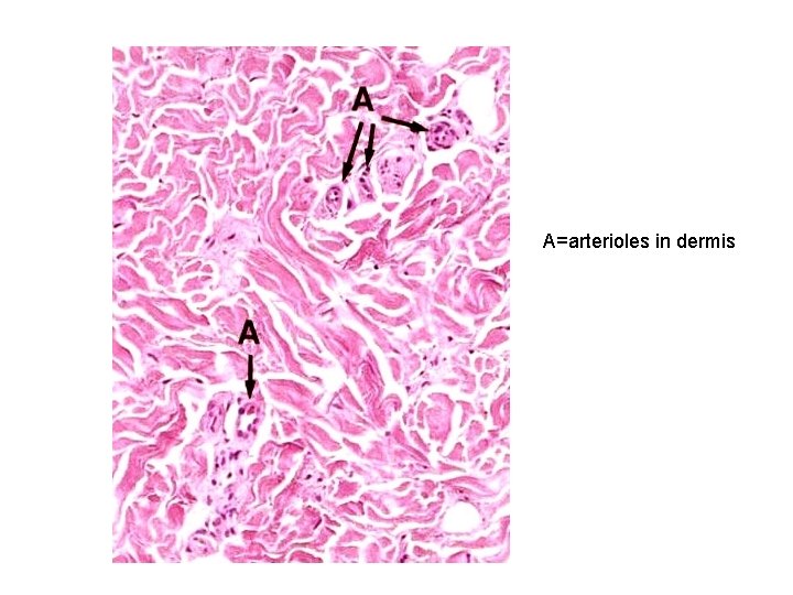 A=arterioles in dermis 