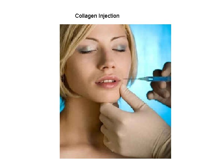 Collagen Injection 