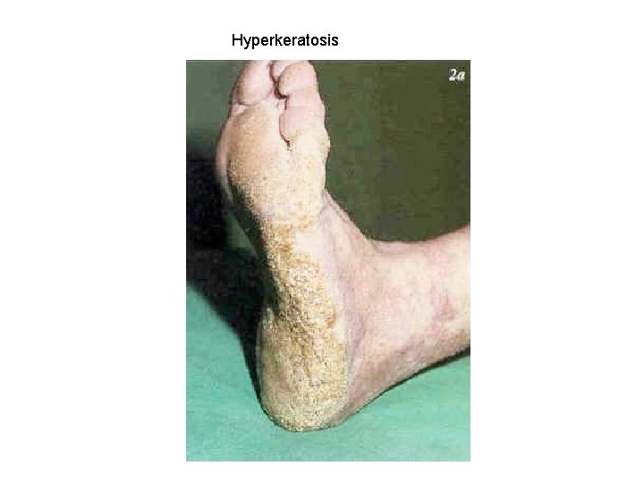 Hyperkeratosis 