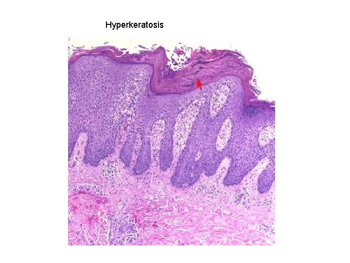 Hyperkeratosis 