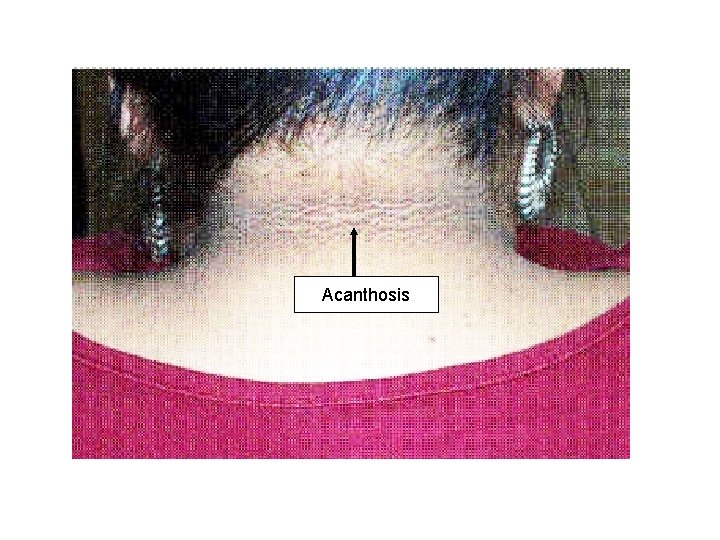 Acanthosis 