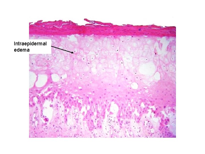 Intraepidermal edema 