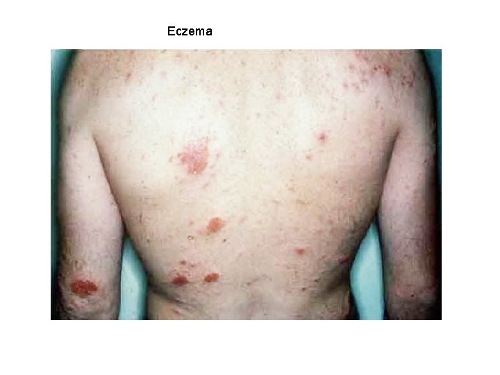 Eczema 