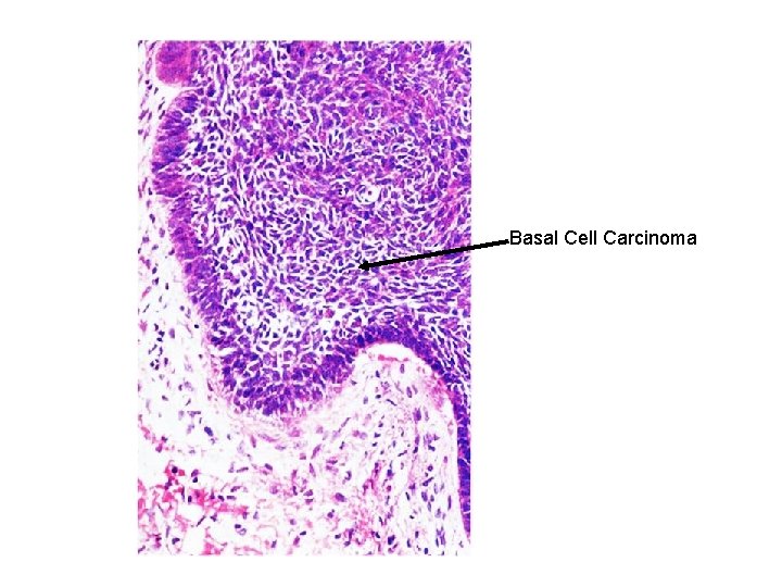 Basal Cell Carcinoma 