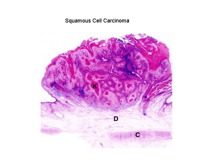 Squamous Cell Carcinoma 