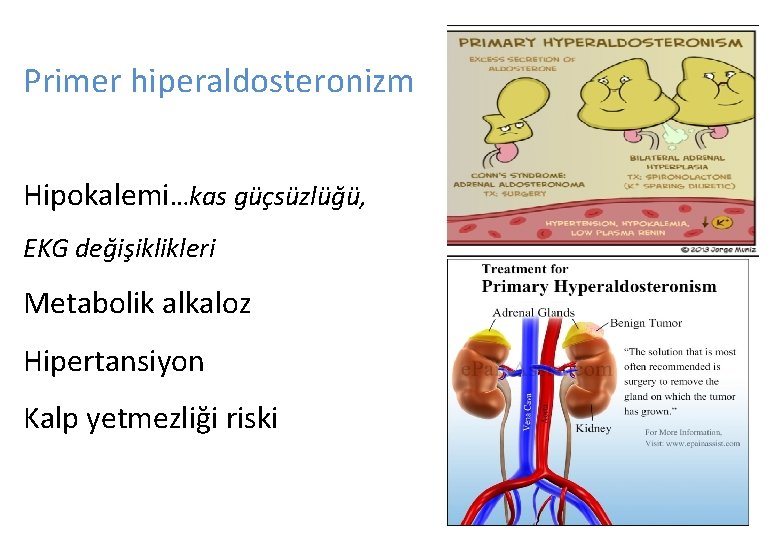 Primer hiperaldosteronizm Hipokalemi…kas güçsüzlüğü, EKG değişiklikleri Metabolik alkaloz Hipertansiyon Kalp yetmezliği riski Primer hiperaldosteronizm Hipokalemi…kas güçsüzlüğü, EKG değişiklikleri Metabolik alkaloz Hipertansiyon Kalp yetmezliği riski