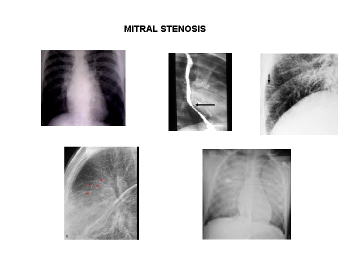 MITRAL STENOSIS 