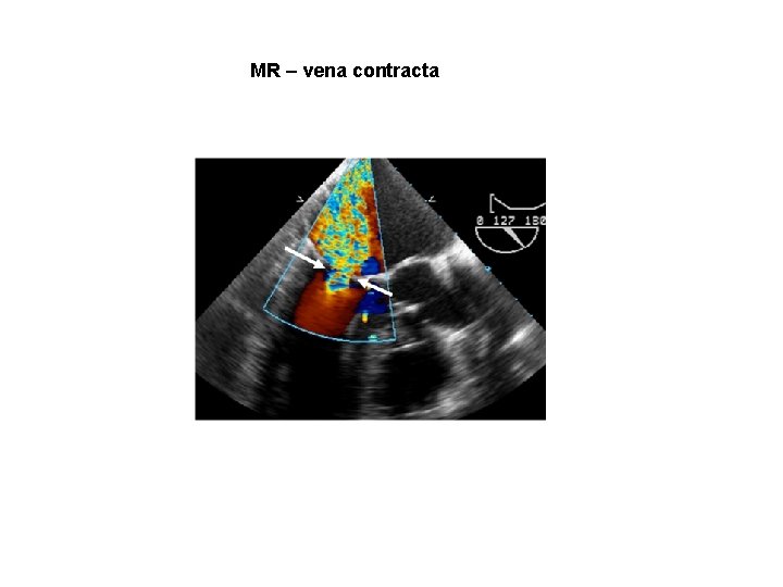 MR – vena contracta 