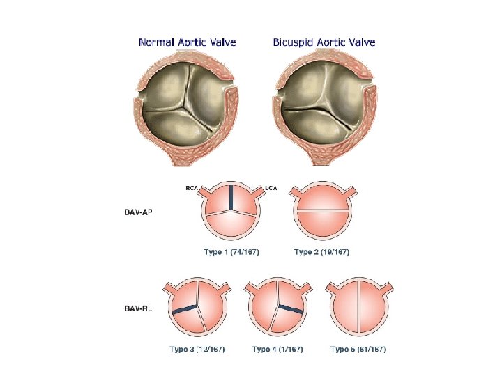 AORTIC STENOSIS 