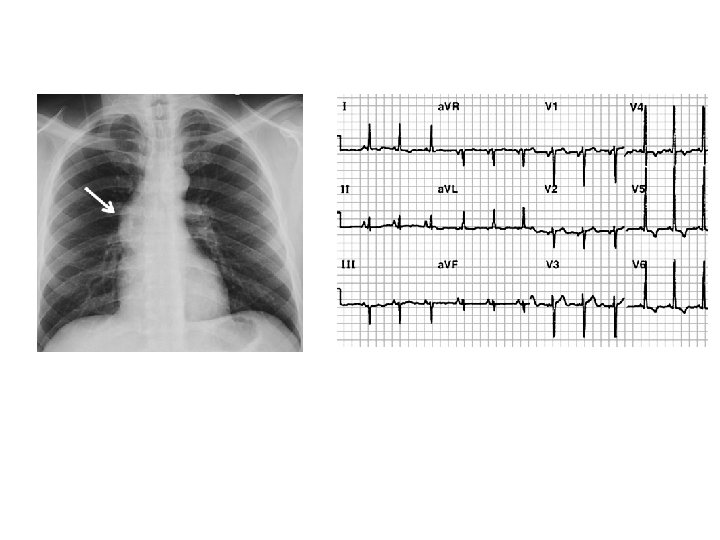 AORTIC STENOSIS 