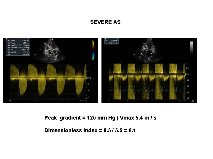 SEVERE AS Peak gradient = 120 mm Hg ( Vmax 5. 4 m /