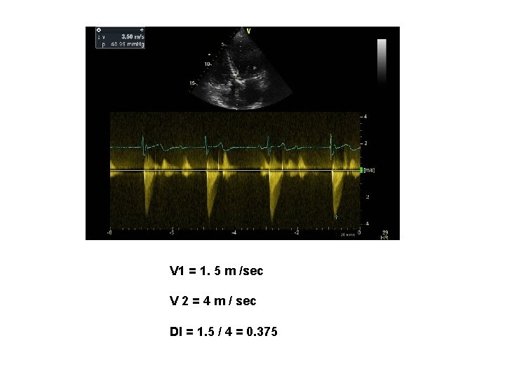 V 1 = 1. 5 m /sec V 2 = 4 m / sec