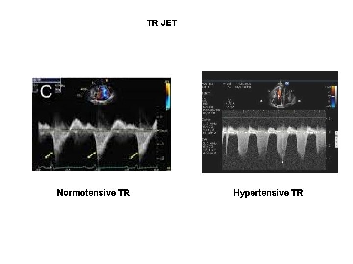 TR JET Normotensive TR Hypertensive TR 