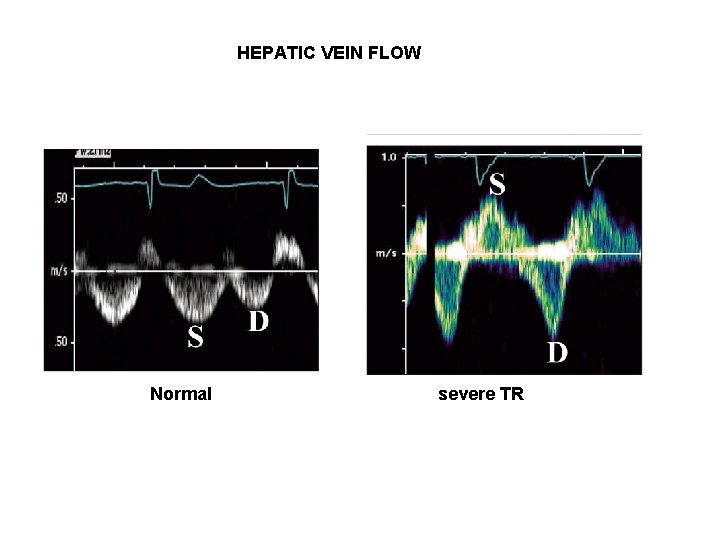 HEPATIC VEIN FLOW Normal severe TR 