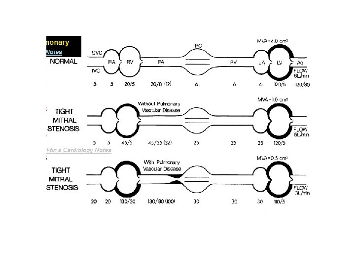 MITRAL STENOSIS 