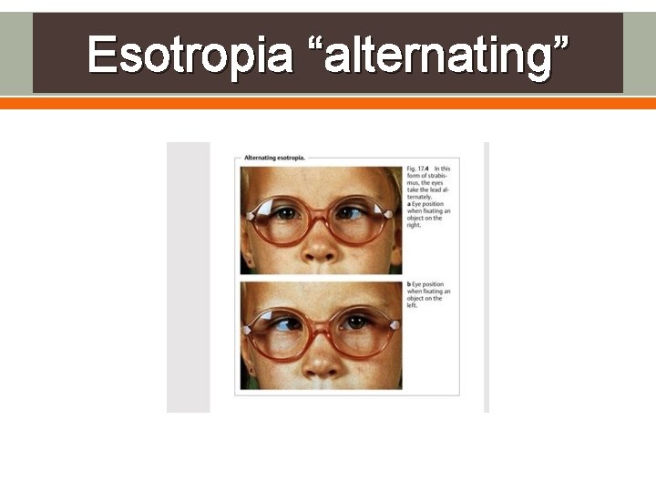 Esotropia “alternating” 