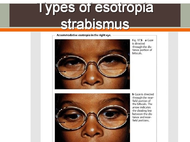 Types of esotropia strabismus 