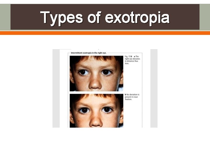Types of exotropia 