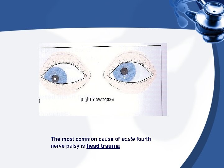 The most common cause of acute fourth nerve palsy is head trauma 