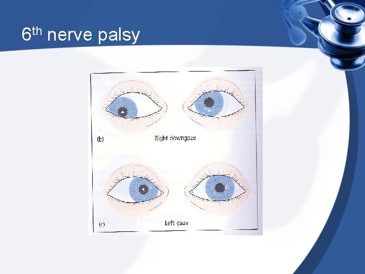 6 th nerve palsy 