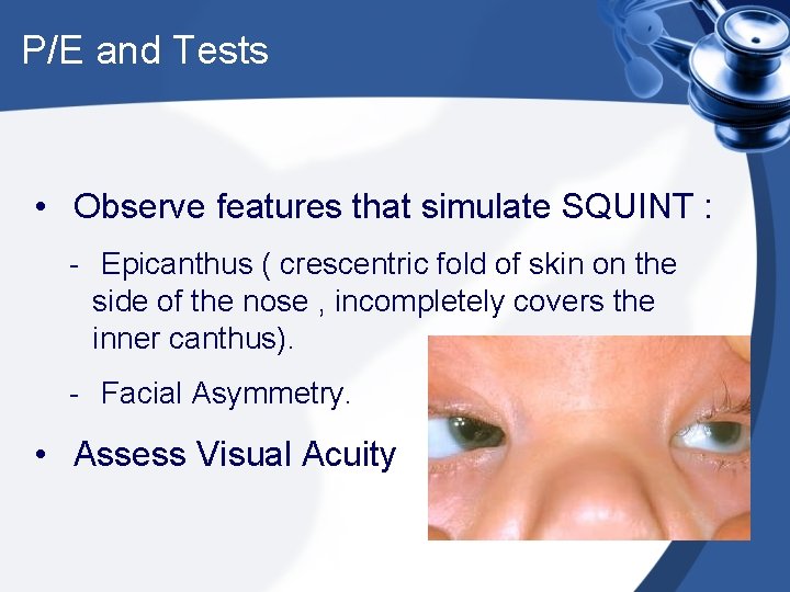 P/E and Tests • Observe features that simulate SQUINT : - Epicanthus ( crescentric