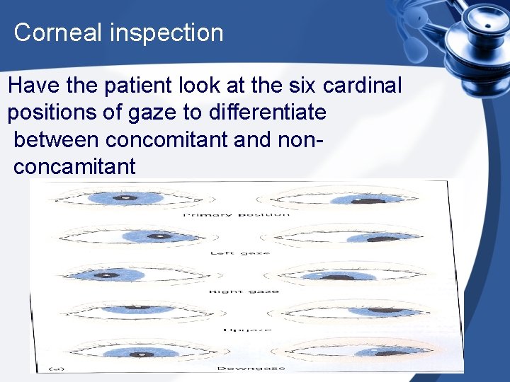 Corneal inspection Have the patient look at the six cardinal positions of gaze to