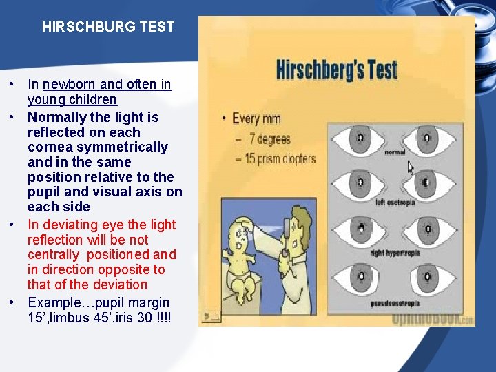 HIRSCHBURG TEST • In newborn and often in young children • Normally the light