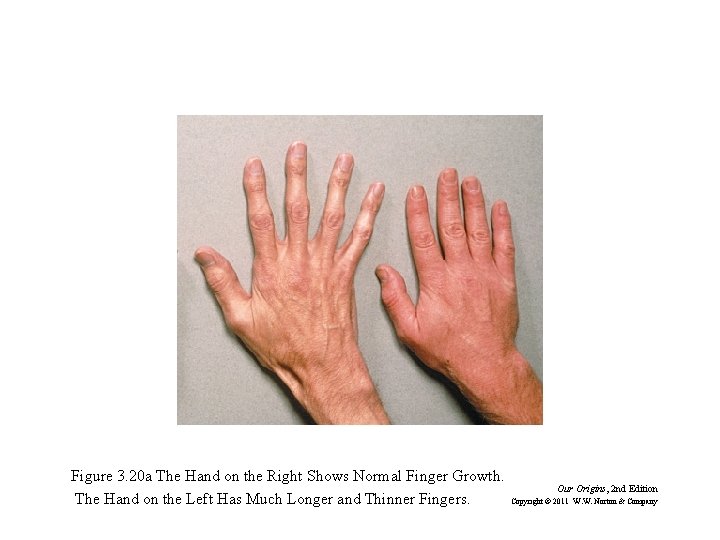 Figure 3. 20 a The Hand on the Right Shows Normal Finger Growth. The