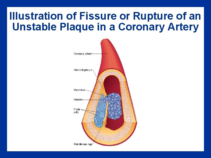 Illustration of Fissure or Rupture of an Unstable Plaque in a Coronary Artery Illustration of Fissure or Rupture of an Unstable Plaque in a Coronary Artery