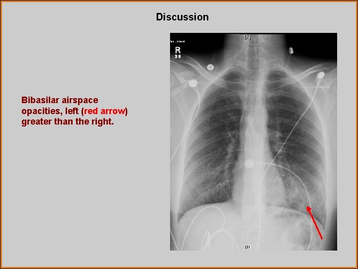 Discussion Bibasilar airspace opacities, left (red arrow) greater than the right. 